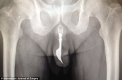 70enne operato per forchetta nei genitali